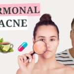 Tea for Hormonal Acne, Herbs, Facials & Male Hormonal Acne