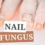 UV Light for Nail Fungus