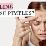 Will Vaseline Cause Pimples
